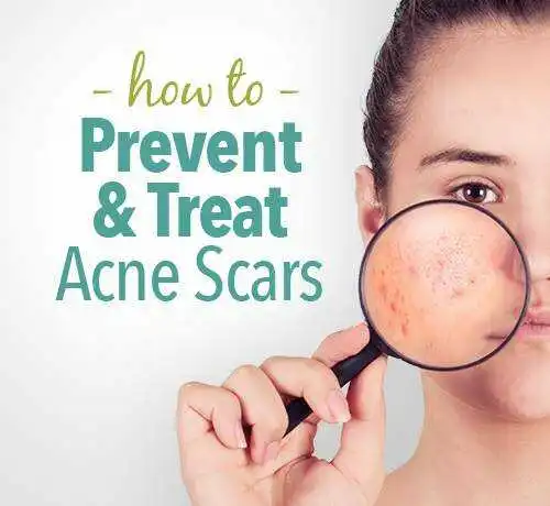 acne scar treatment