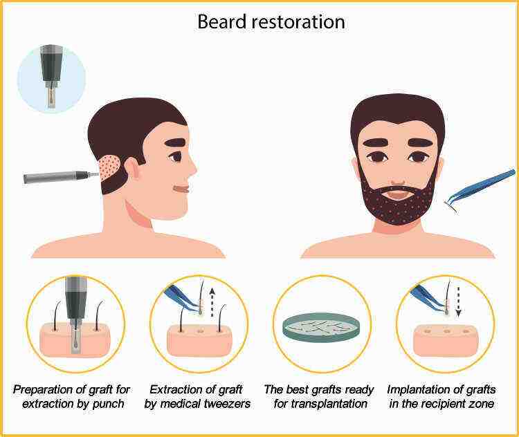 Beard Hair Transplant