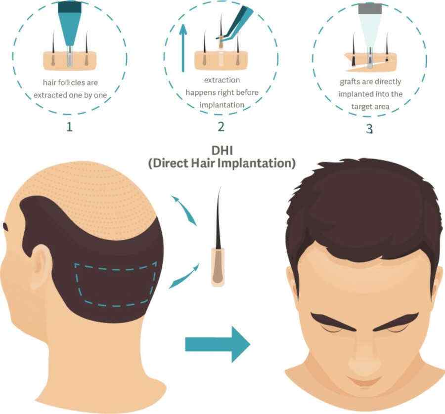 direct hair implantation